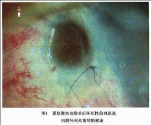 革兰阴性杆菌肺炎