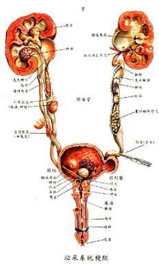 泌尿系统结石