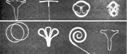 X线下的节育环影像