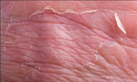 常见的切削液产品对皮肤的刺激和破坏