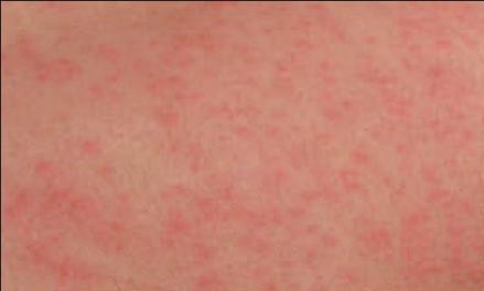 常见的切削液产品对皮肤的刺激和破坏