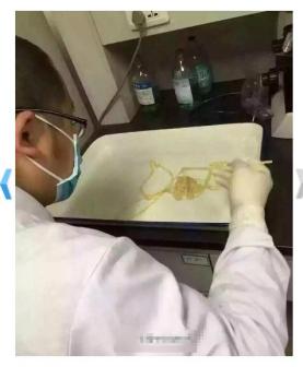 吃生肉体内取出5米长牛带绦虫