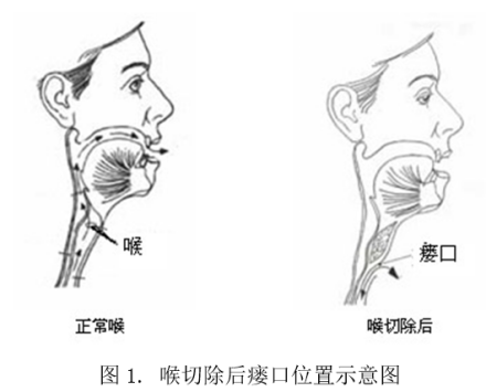 图1.喉切除后楼口位置示意图