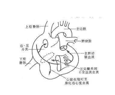 三尖瓣下移畸形
