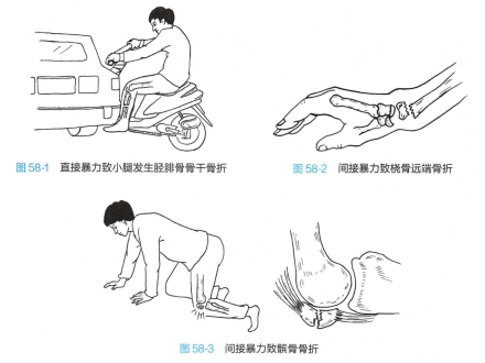骨折的病因 