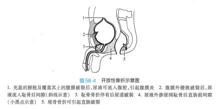 开放性骨折示意图 