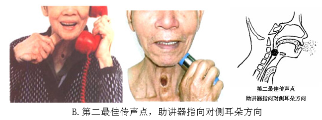 第二最佳传声点，助讲器指向对侧耳朵方向