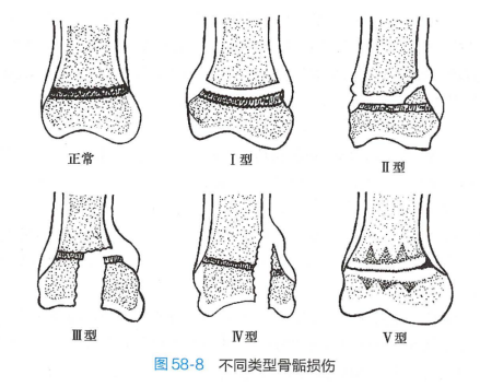 骨骺损伤的类型 