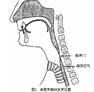 图2. 食管声振动发声位置示意图