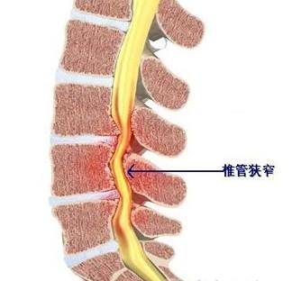 椎管狭窄