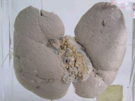 肾脏纤维化