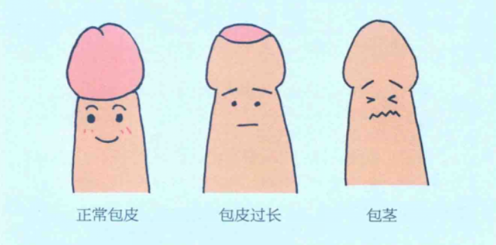 包皮三种情况（正常、包皮过长、包茎）示意图 
