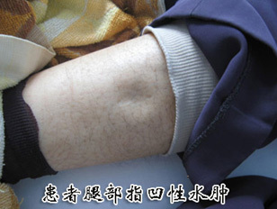 肾性浮肿 