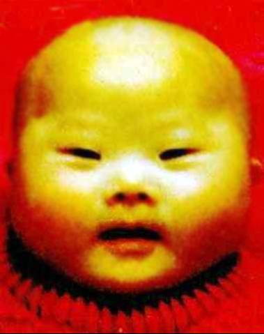 染色体病