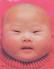 21-三体综合征