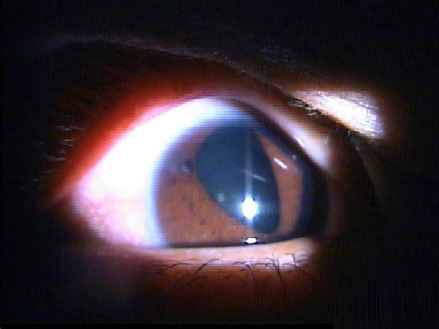 虹膜炎虹膜后粘连