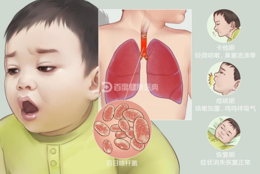 百日咳 百日咳