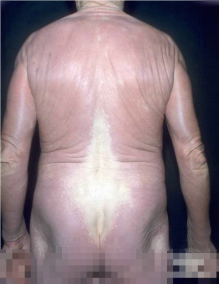 全身黏液性水肿