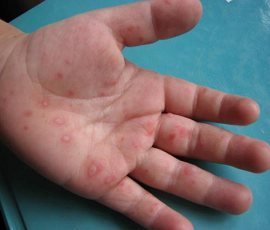 手足口病——肠道病毒71型感染性疾病知识