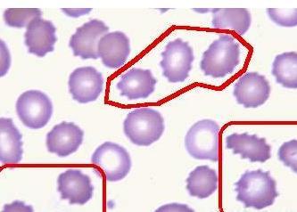 遗传性椭圆形红细胞增多症