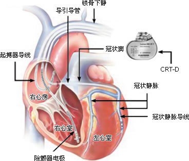 起搏器原理