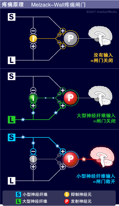 疼痛原理-疼痛的闸门控制理论