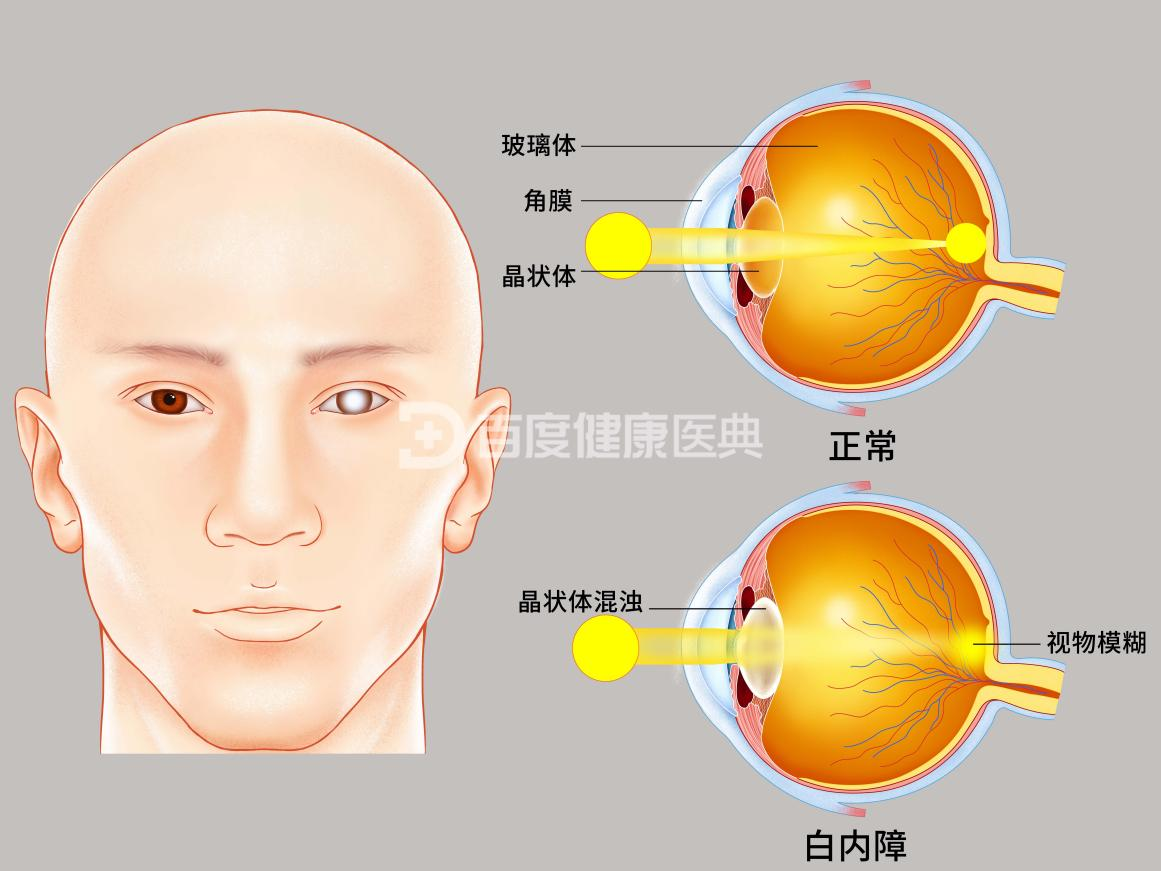 白内障的典型症状