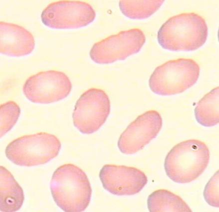 遗传性椭圆形红细胞增多症