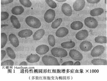 遗传性椭圆形红细胞增多症