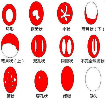 图1 处女膜形态