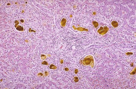 肝脏小胆管内可见黄绿色球状物，其为胆红素