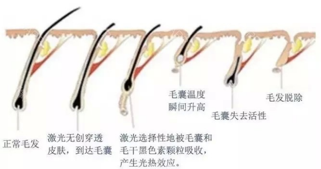 激光脱毛原理