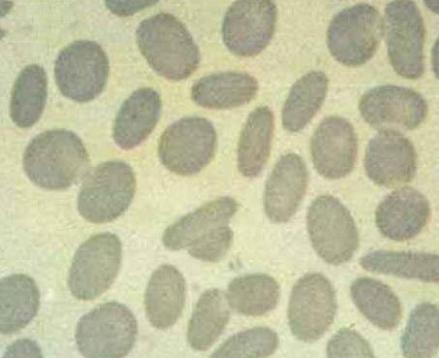 遗传性椭圆形红细胞增多症