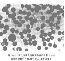 遗传性椭圆形红细胞增多症