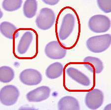 遗传性椭圆形红细胞增多症