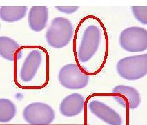 遗传性椭圆形红细胞增多症