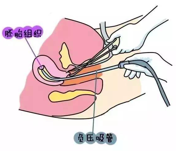 负压吸宫术手术示意图 