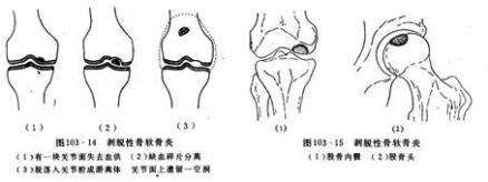 剥脱性骨软骨炎
