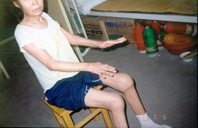 风湿病
