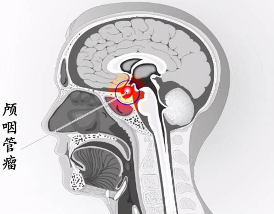 颅咽管瘤 颅咽管瘤