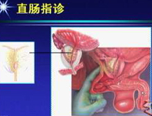 直肠指诊取前列腺液