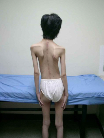小儿急性特发性神经炎