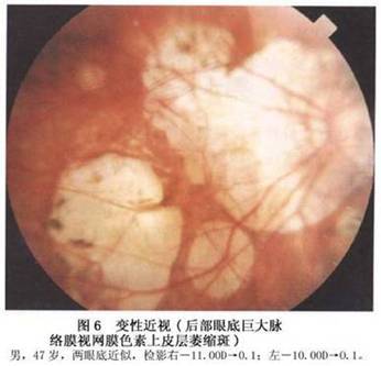萎缩斑 